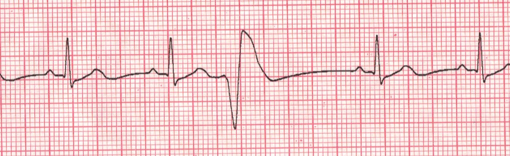 درمان آریتمی قلبی