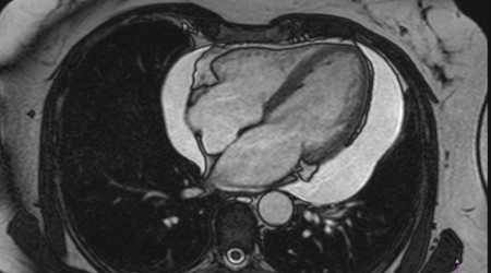 پریکاردیت 🔗