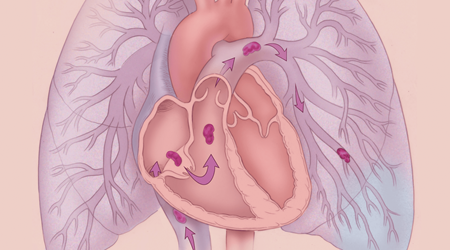 آمبولی ریه 🔗
