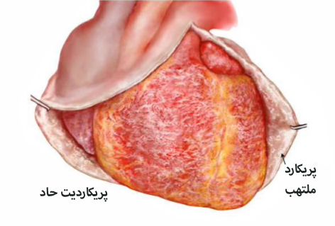 علایم پریکاردیت