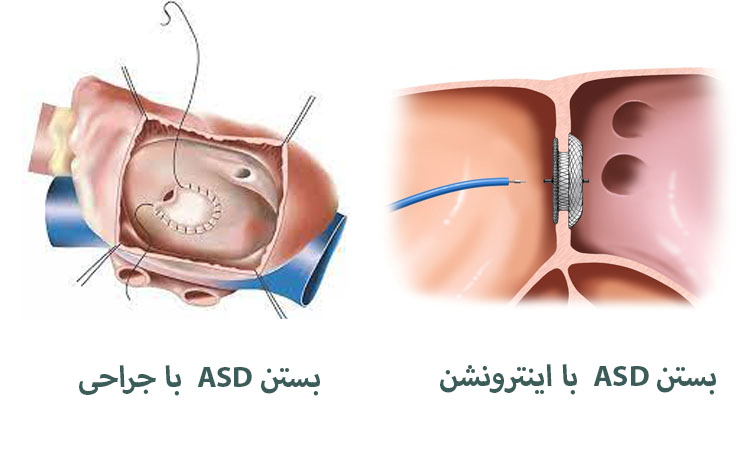 درمان asd