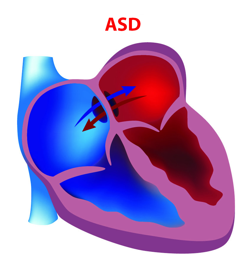 ASD