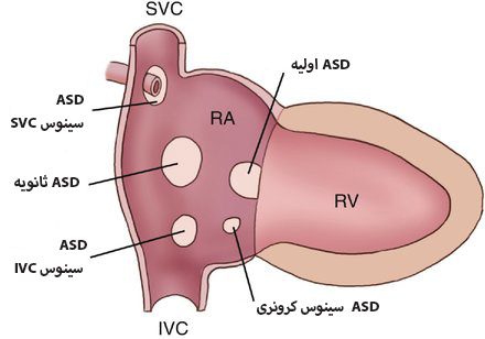 انواع ASD