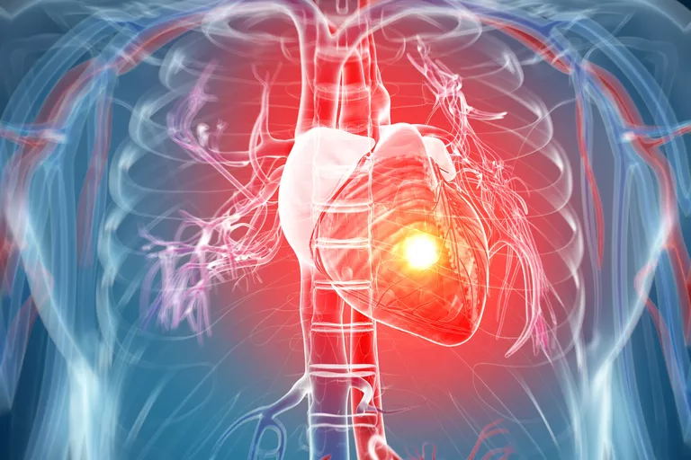 حمله حاد قلبی و علل آن