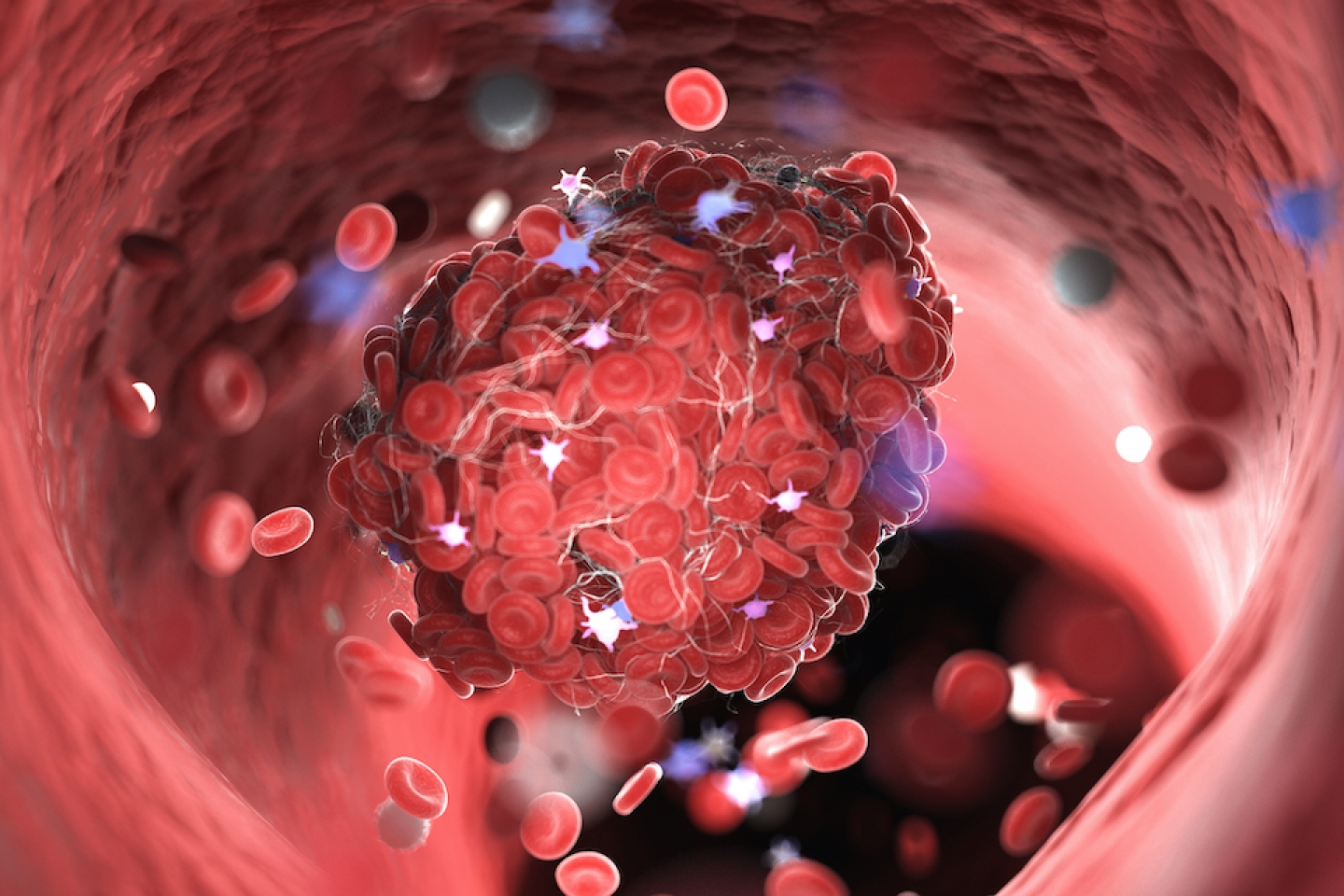 ترومبوز و لخته شدن خون بعد از واکسن کرونا