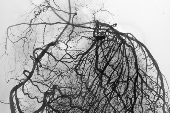 آیا بیماری عروق کرونری، صرفاً تنگی عروق قلبی است؟