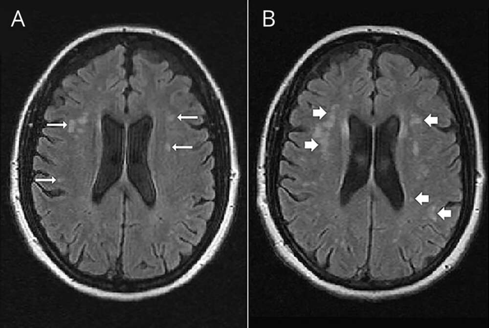 عوارض و خطرات PFO